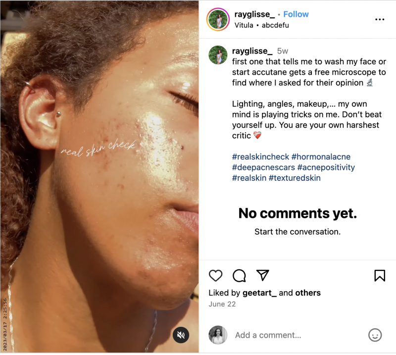   Une bobine Instagram d'une micro-influenceuse (l'un des membres de Topicals Hype) montrant son hyperpigmentation et ses cicatrices d'acné. La vidéo's text overlay says Real Skin Check.